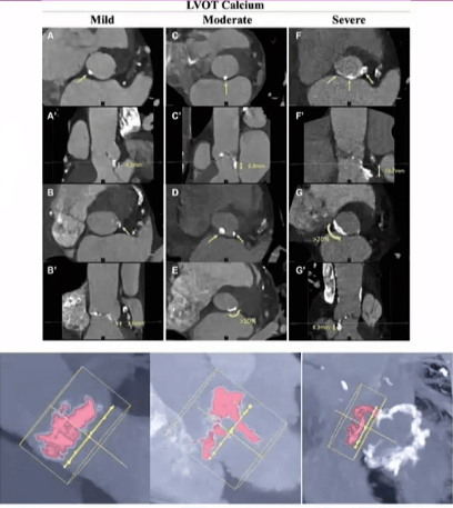 EuroPCR 2024｜陈茂教授：高度钙化的三叶式主动脉瓣狭窄患者行TAVI面临的挑战