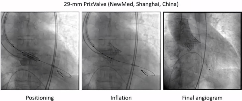 EuroPCR 2024｜陈茂教授：高度钙化的三叶式主动脉瓣狭窄患者行TAVI面临的挑战