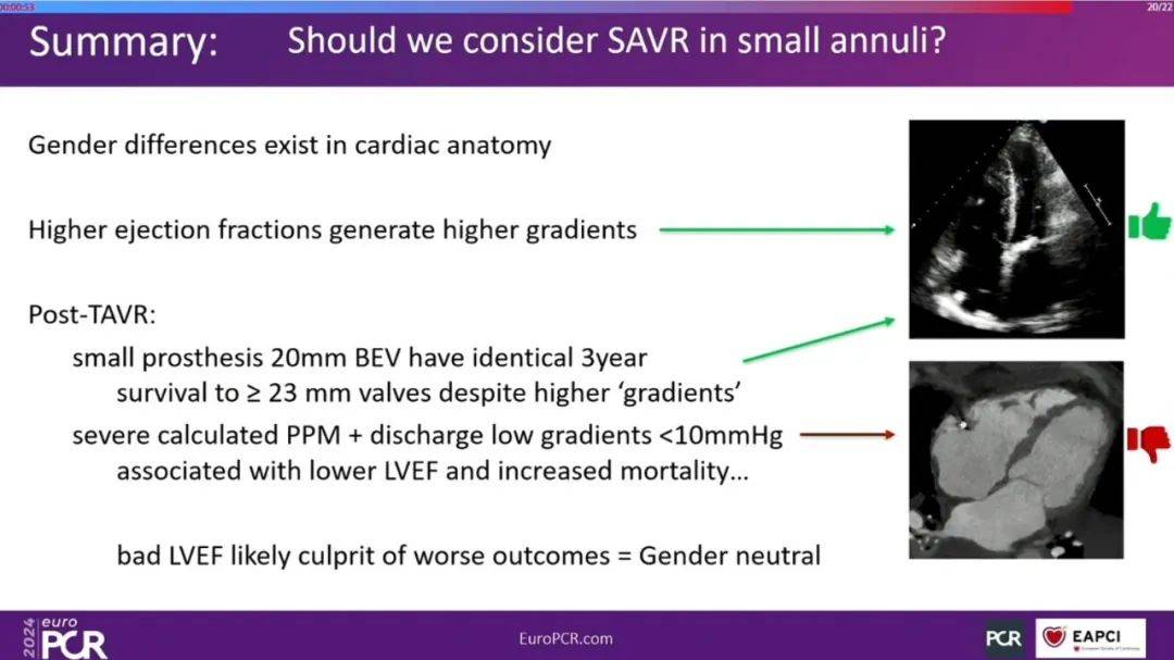 EuroPCR 2024｜女性患者重度主动脉瓣狭窄和主动脉瓣介入治疗的当代洞察