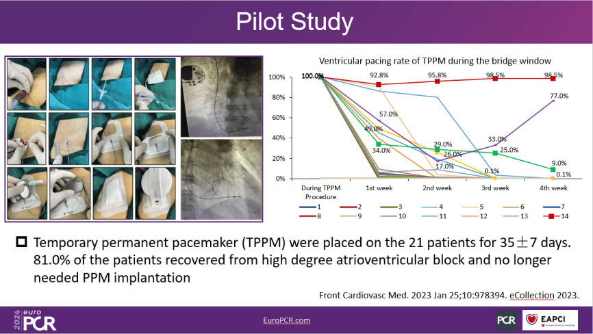 EuroPCR 2024｜宋光远教授：TAVI术后传导阻滞患者应用过渡起搏器可减少不必要永久起搏器植入